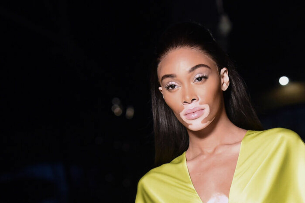 Supermodellen Sinne Harlow har blivit ansiktet utåt för hudåkomman vitiligo. Supermodellen Sinne Harlow har blivit ansiktet utåt för hudåkomman vitiligo.